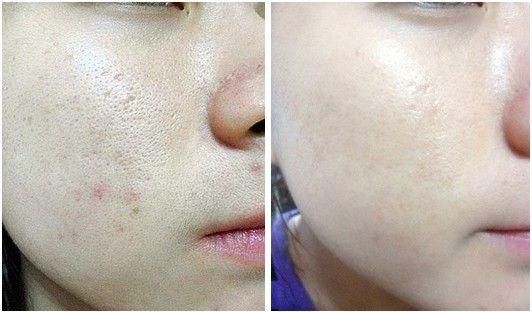 黑頭毛孔粗大油膩用什么產(chǎn)品好_黑頭毛孔粗大油皮怎么辦_毛孔粗大黑頭多皮膚油應(yīng)該怎么辦